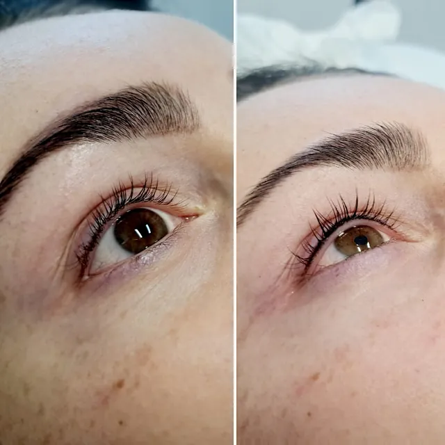 Wimpernkranzverdichtung